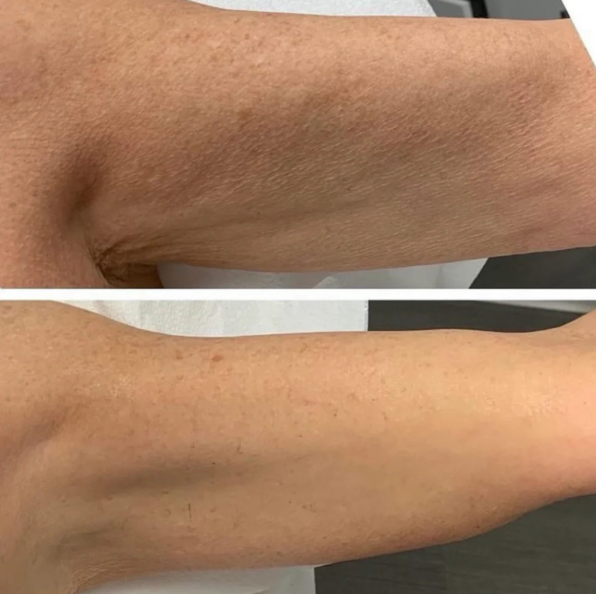 Lipid Body Treatment