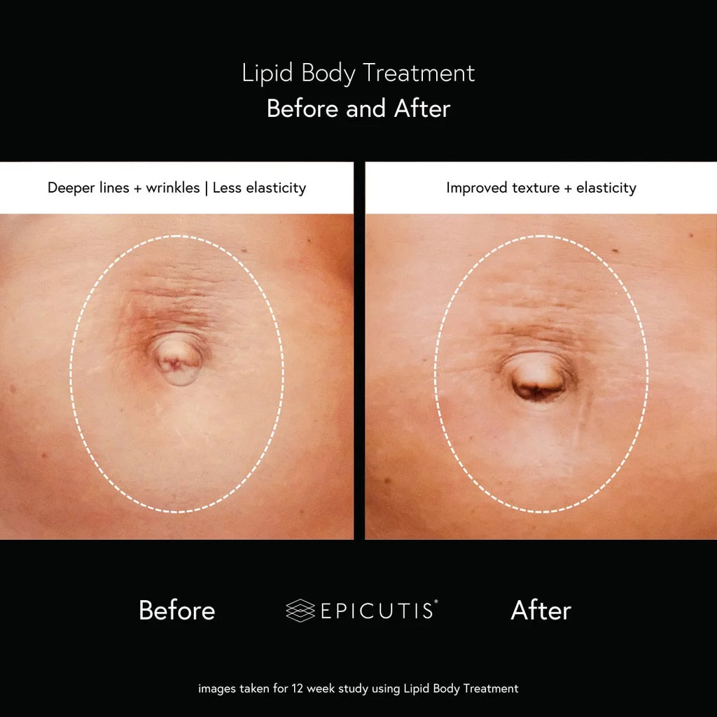 Lipid body treatment travel size