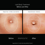 Lipid body treatment travel size